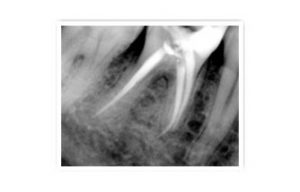 Root canal 2
