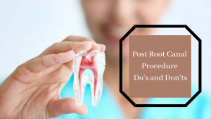 Rootcanal treatment in pune