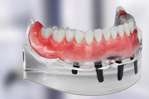 Implant supported dentures in pune