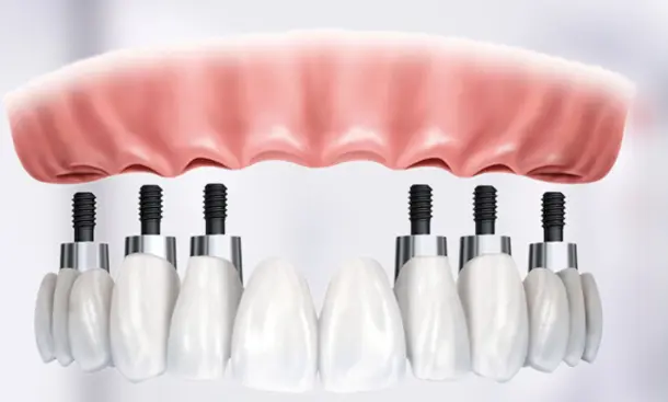 Multiple tooth implants in pune