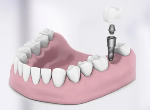 Single tooth implants in pune