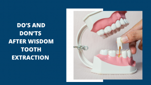 Do’s and don’ts after wisdom tooth extraction.  