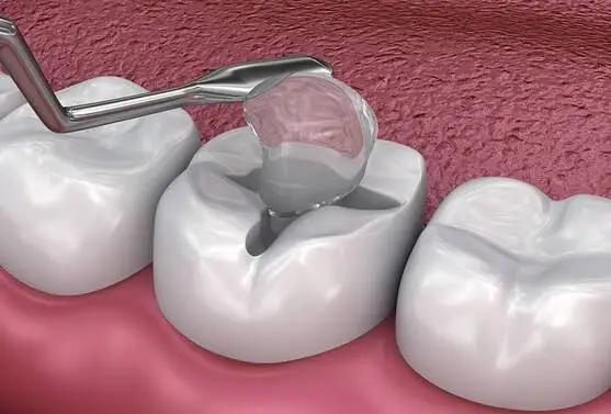 Glass ionomers dental fillings