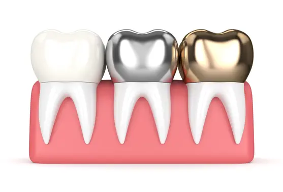 Tooth crowns- gold and silver
