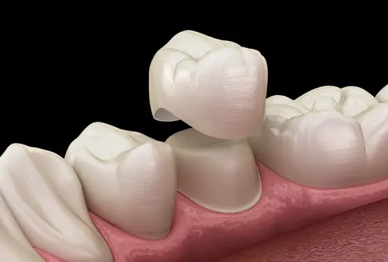 Tooth crowns