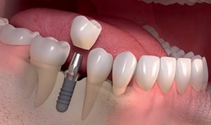 Immediate Implants