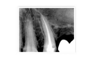Root canal 1