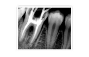 Root canal 4