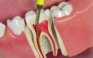 Root canal procedure guide 300x189 1