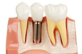 Dental Implants in Pune