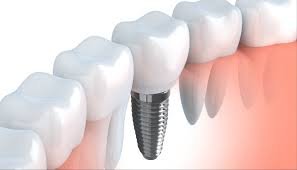 Conventional Implants