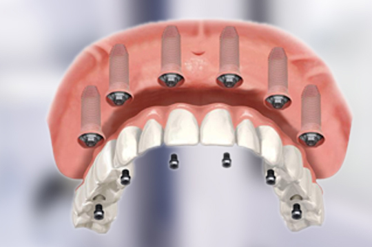 All On Four & All On Six Dental Implant In Pune - Dev's Oral Care