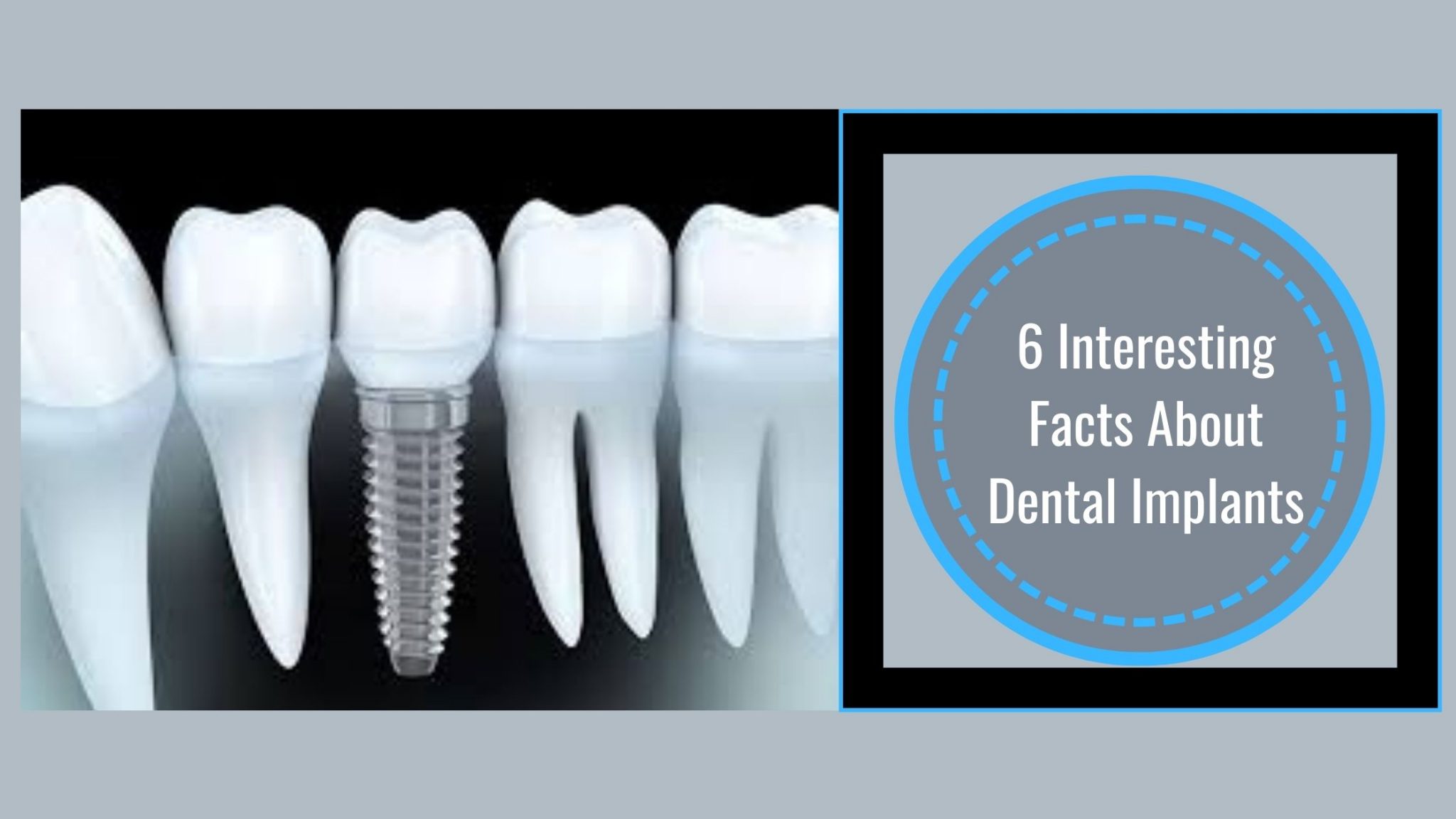 6 Interesting Facts About Dental Implants