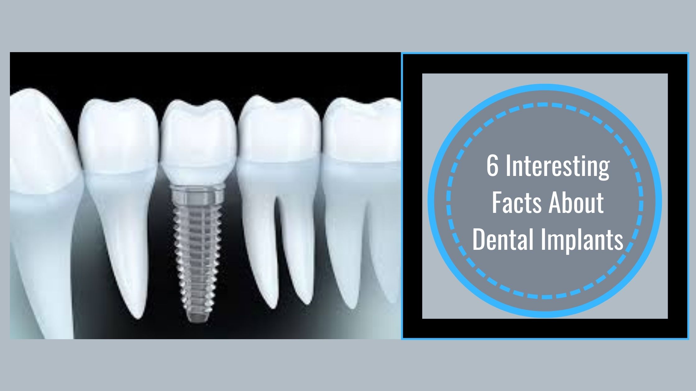 Dental implants in pune