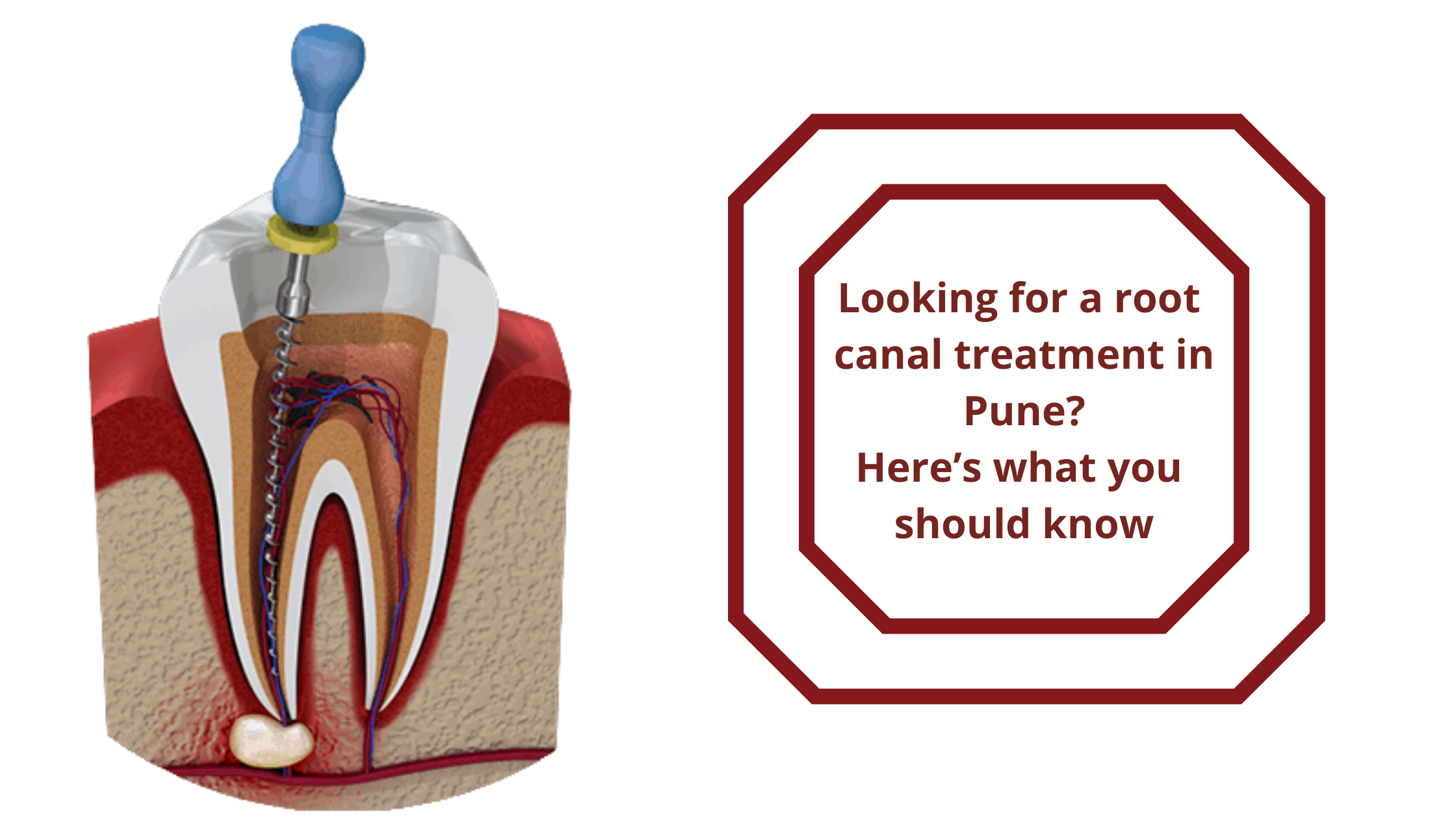 Rootcanal treatment in pune