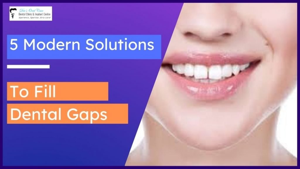 5 Modern Solutions To Fill Dental Gaps