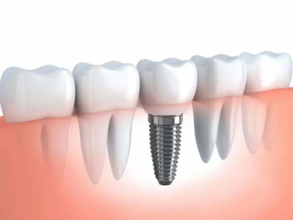 Dental implants treatment in pune