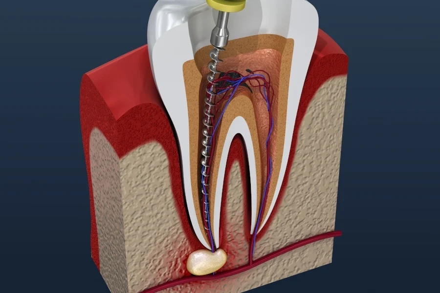 Root canal treatment in pune infographics image