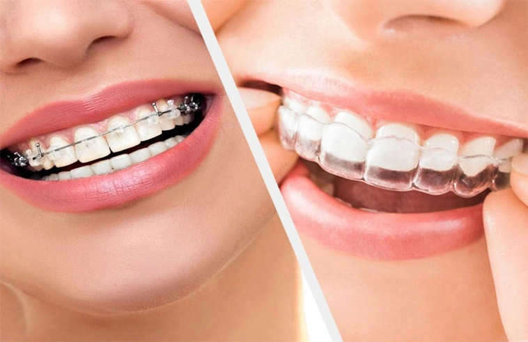 Orthodontic treatment in pune at devs oral care