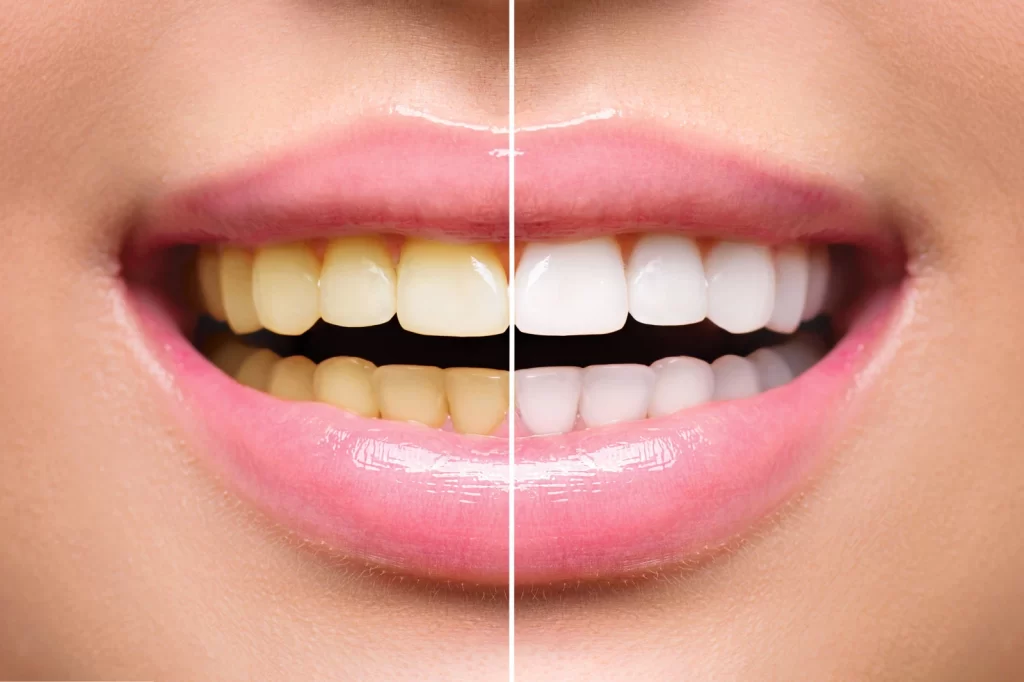 Teeth whitening treatment in pune at devs oral care