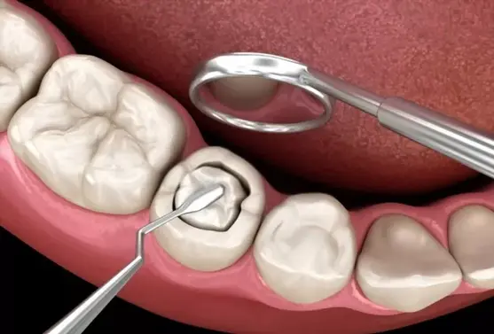 Composite fillings in teeth