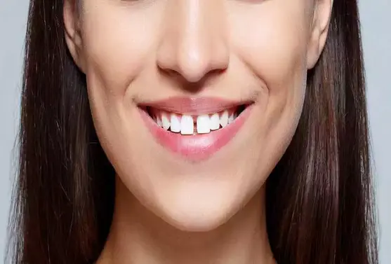 Gap fillings between teeth