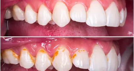 Oral prophylaxis- before- after