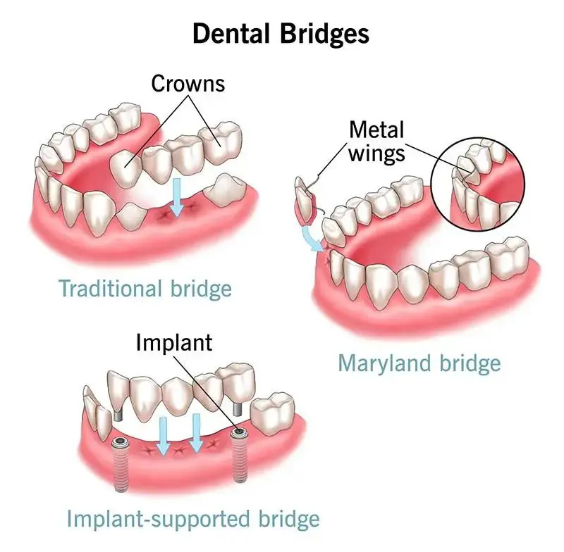 Indirect restorations