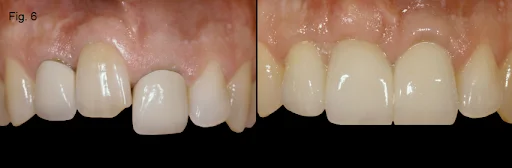 Image showing signs of an ankylosed tooth