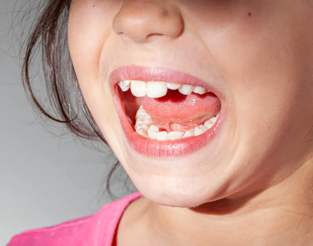 Dangling Tooth Ankylosed Tooth: What You Need to Know?