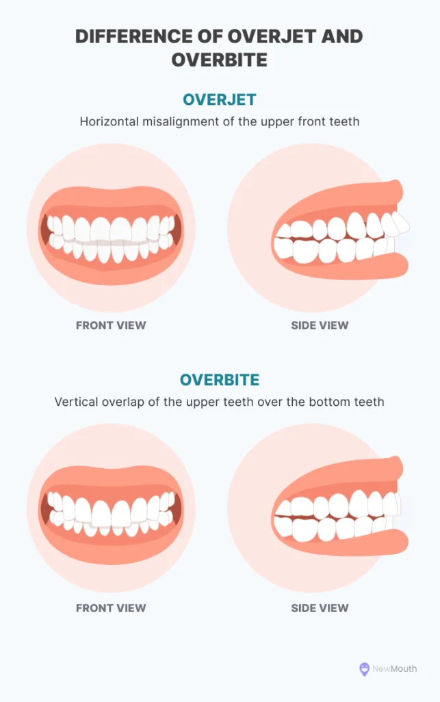 Difference between overjet and overbite