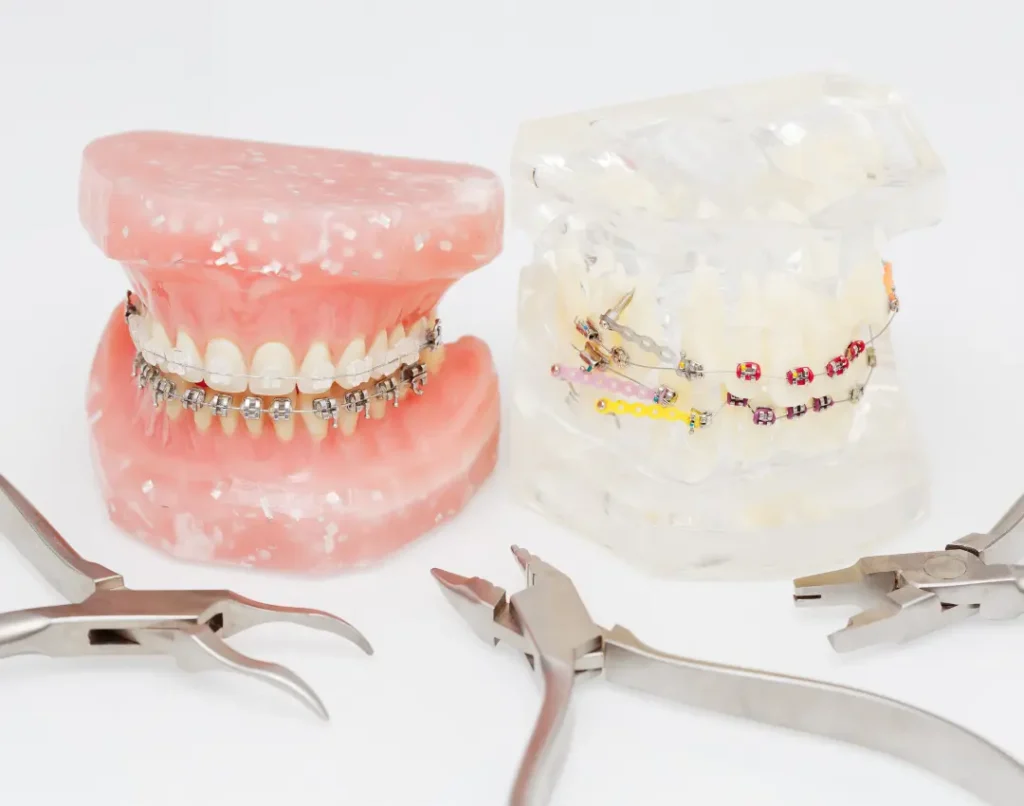 Types of Retainers After Braces Which One Is Right for You- featured image