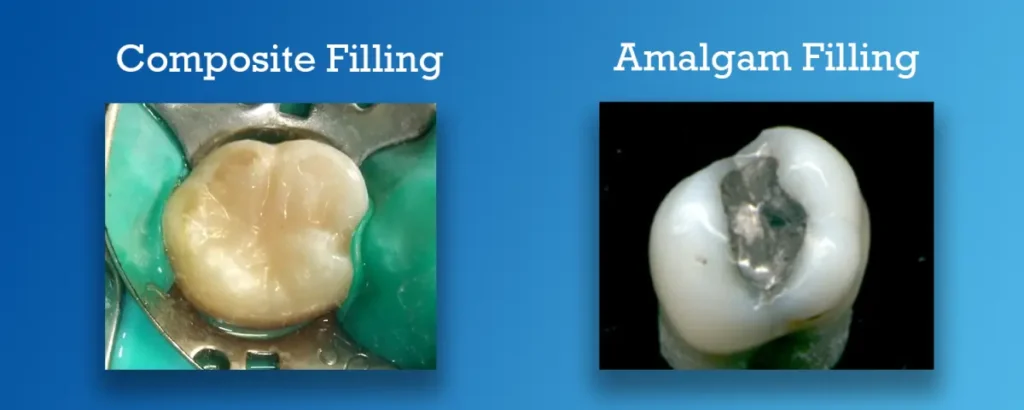 Comparison of composite filling and amalgam filling on molar teeth