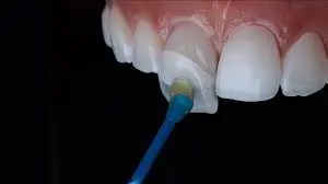 Close-up of dental veneer being applied to a tooth using a bonding tool