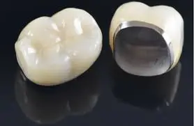 Two dental crowns, one showing the tooth-colored exterior and the other revealing the metal base used for strength