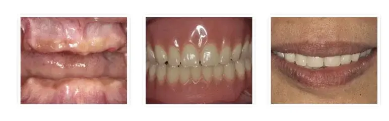 Before and after full denture placement in lower jaw