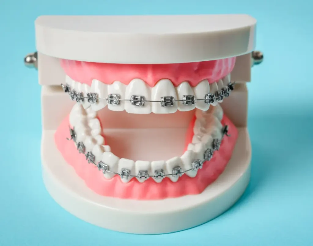 How Do Braces Work Your Complete Guide to Orthodontic Treatment- featured image