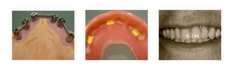 Upper jaw showing implant-supported denture structure