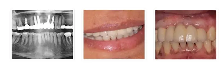 X-ray and photos showing before and after dental implant treatment