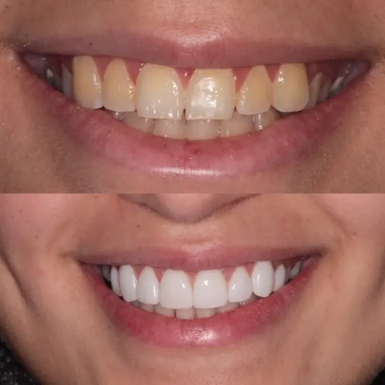 Before and after smile showing dental veneers transformation
