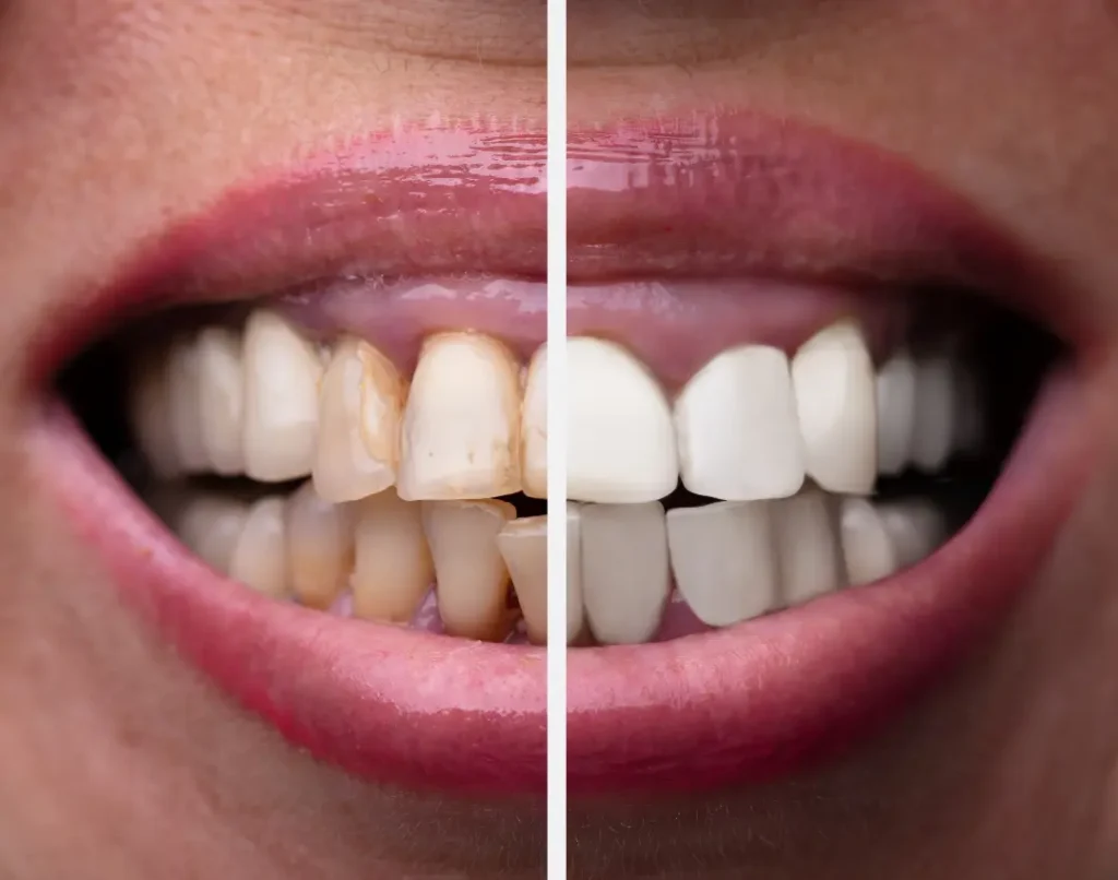 Full Mouth Rehabilitation vs Smile Makeover Featured Image