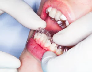 Blog 103 Orthodontic Treatment