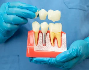 Dental Bridge vs Implant