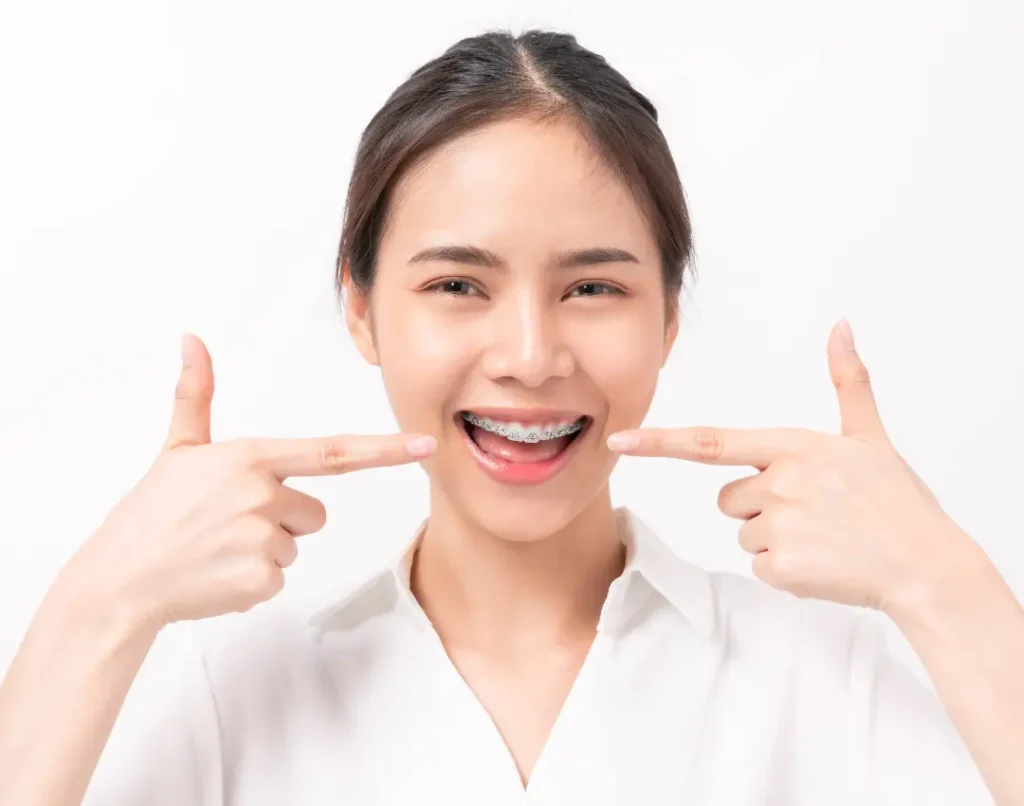 How Long Do Braces Take to Straighten Teeth Featured Image