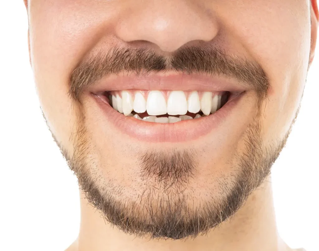 What Are the Benefits of a Full Smile Makeover